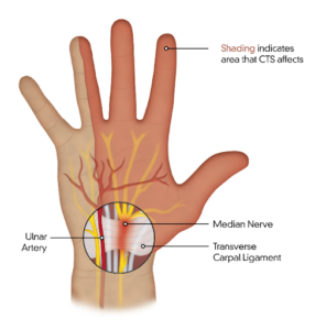 Carpal Tunnel Syndrome Pain